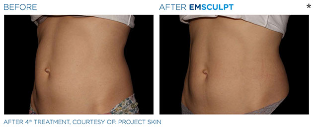 Before and After Photo of abdomen scultping Treatment in Merrimack